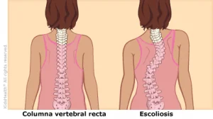 Escoliosis: Causas, diagnóstico y tratamiento - Policlínica