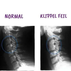 KLIPPEL-FEIL