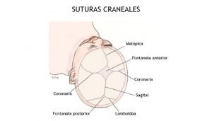 craneosinostosis suturas craneales